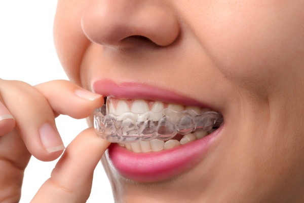 Wonders of Invisalign for a Confident Smile Transformation