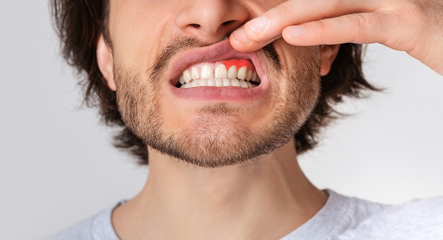What Are the Symptoms of Gum Disease?