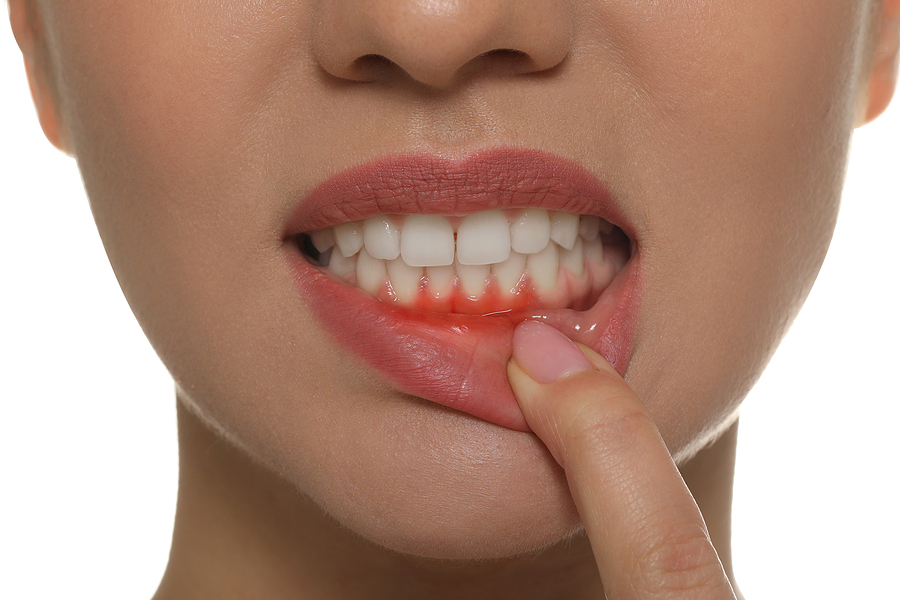 What Are the Causes of Gum Disease?