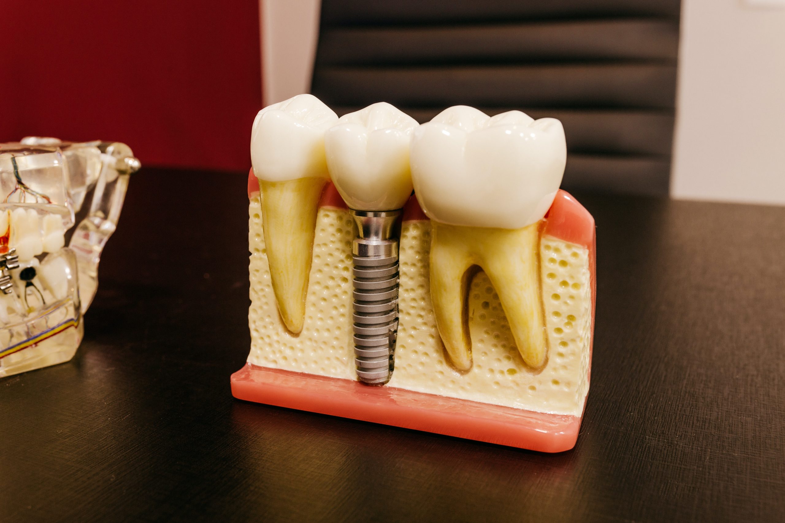 Why Are Dental Implants So Effective?
